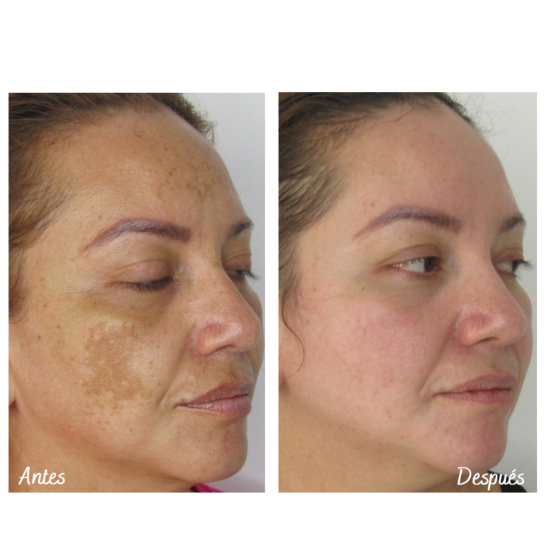 Tratamiento láser para remoción de manchas solares en Cali con el Dr. Oscar Gaona