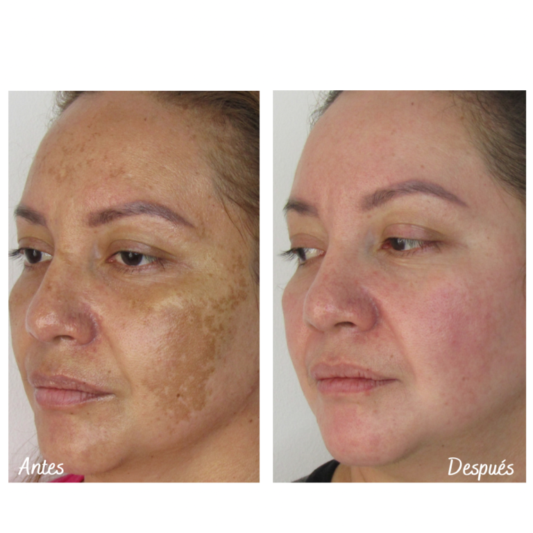 Tratamiento láser para remoción de manchas solares en Cali con el Dr. Oscar Gaona
