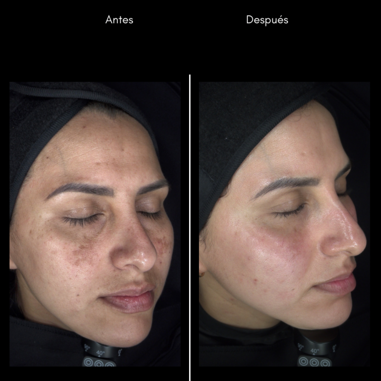 Tratamiento láser para remoción de manchas solares en Cali con el Dr. Oscar Gaona