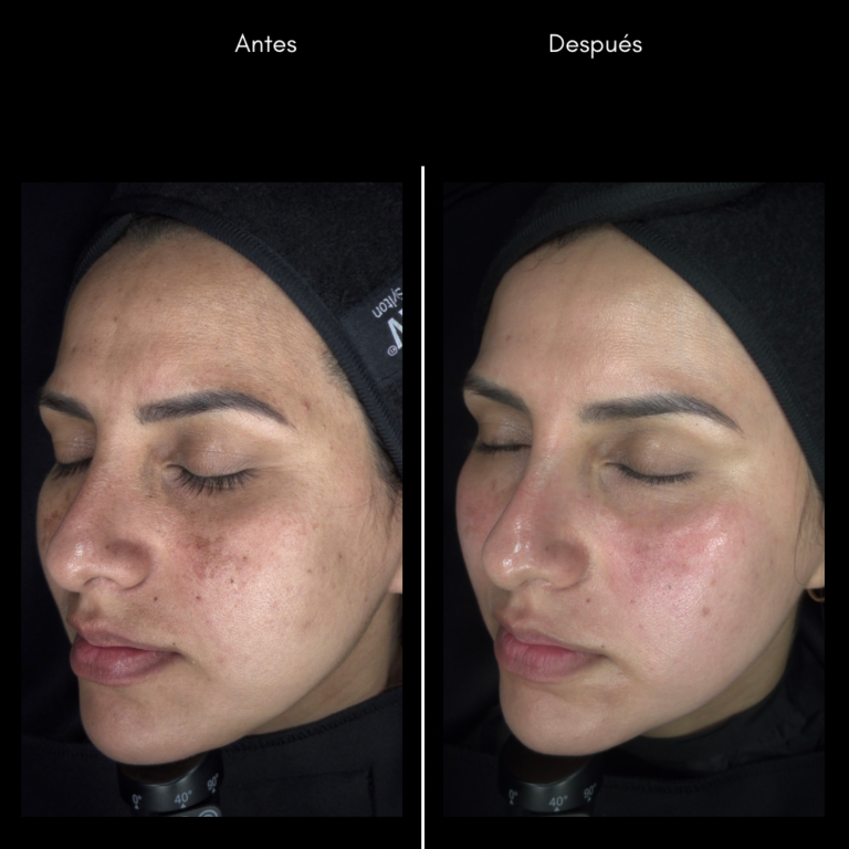 Tratamiento láser para remoción de manchas solares en Cali con el Dr. Oscar Gaona