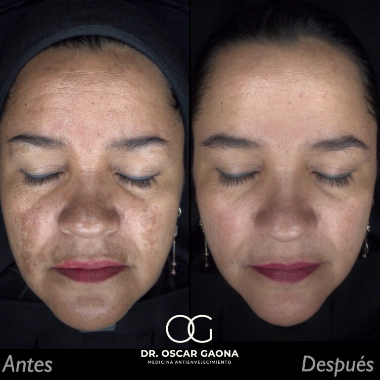 Tratamiento láser para remoción de manchas solares en Cali con el Dr. Oscar Gaona