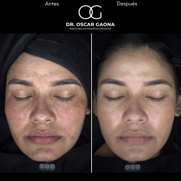 Tratamiento láser para remoción de manchas solares en Cali con el Dr. Oscar Gaona