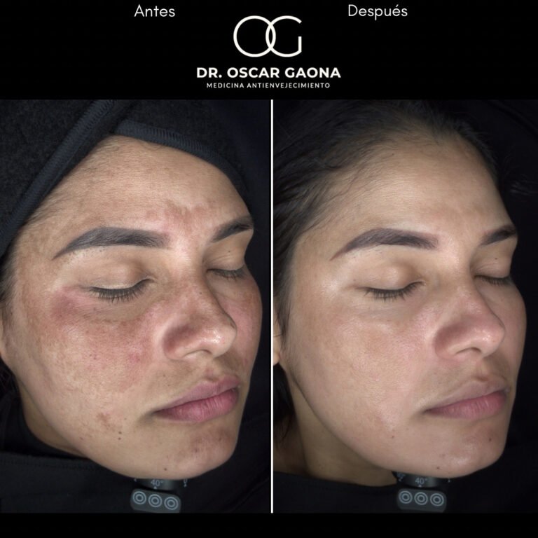 Tratamiento láser para remoción de manchas solares en Cali con el Dr. Oscar Gaona