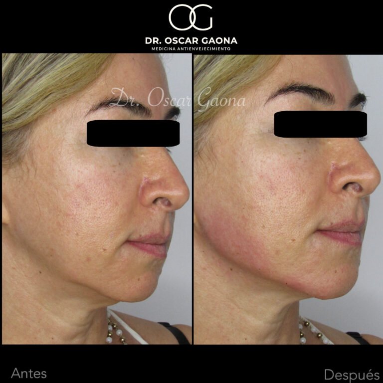 Tratamientos Estéticos - Dr. Óscar Gaona en Cali 15