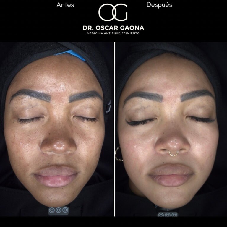 Tratamientos Estéticos - Dr. Óscar Gaona en Cali 21