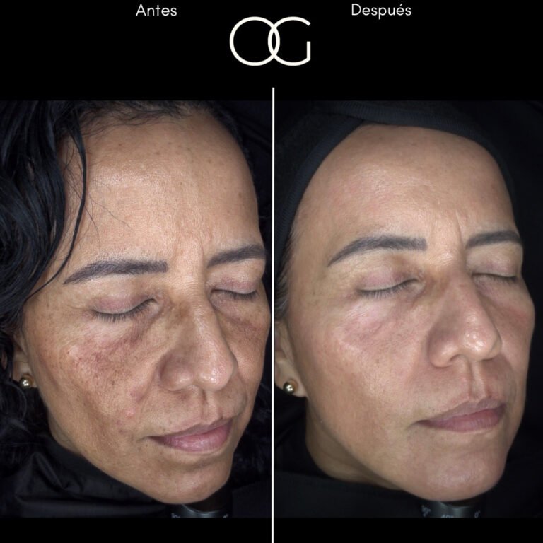 Tratamiento láser para remoción de manchas solares en Cali con el Dr. Oscar Gaona