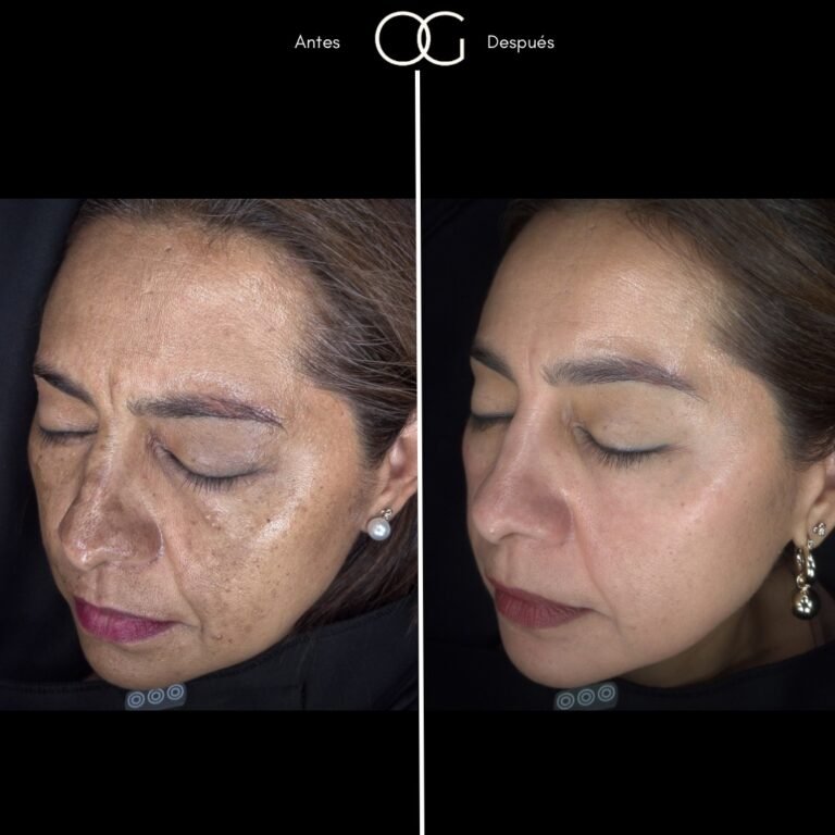 Tratamiento láser para remoción de manchas solares en Cali con el Dr. Oscar Gaona