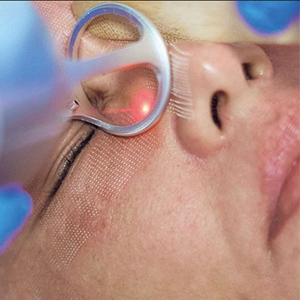 Láser CO2 - Dr. Óscar Gaona en Cali 3