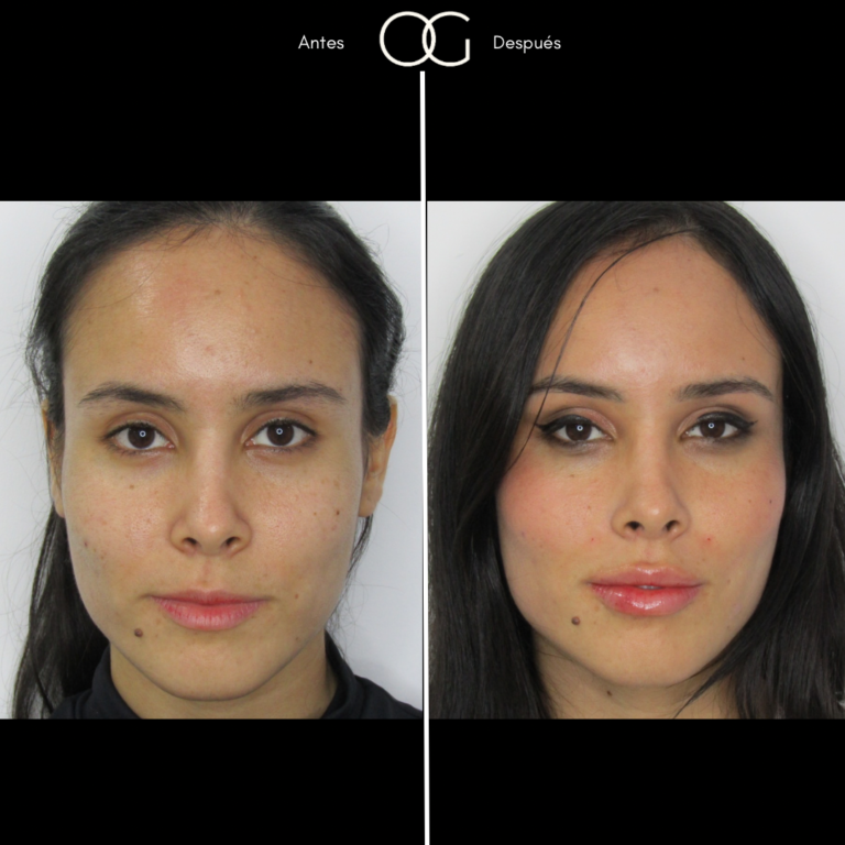 Tratamientos Estéticos - Dr. Óscar Gaona en Cali 17