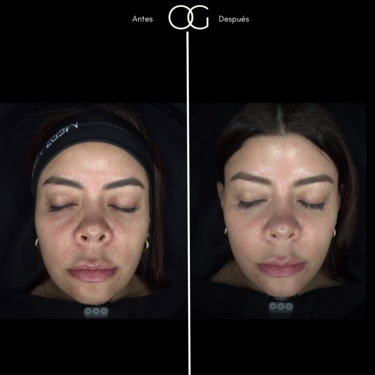 Tratamientos Estéticos - Dr. Óscar Gaona en Cali 20
