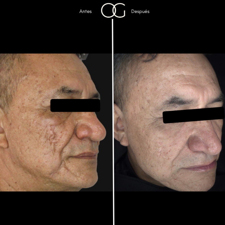 Tratamientos Estéticos - Dr. Óscar Gaona en Cali 5